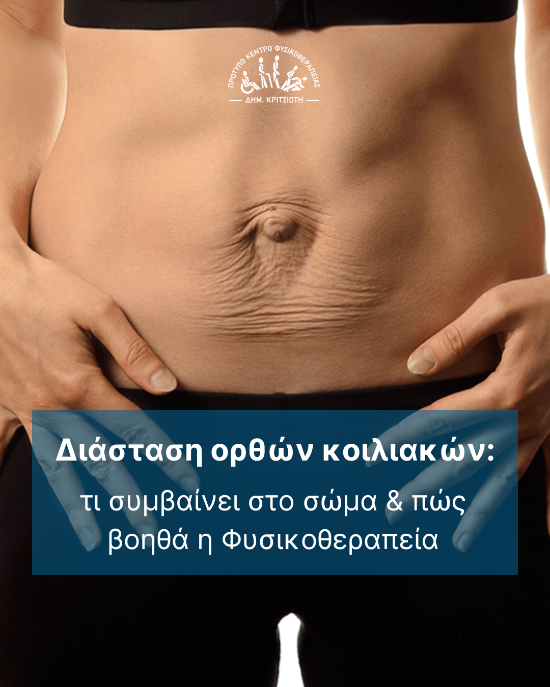 διάσταση ορθών κοιλιακών cover