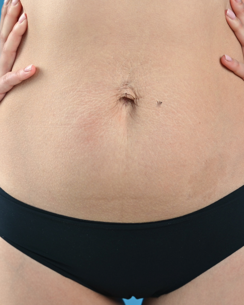 διάσταση ορθών κοιλιακών diastasis recti
