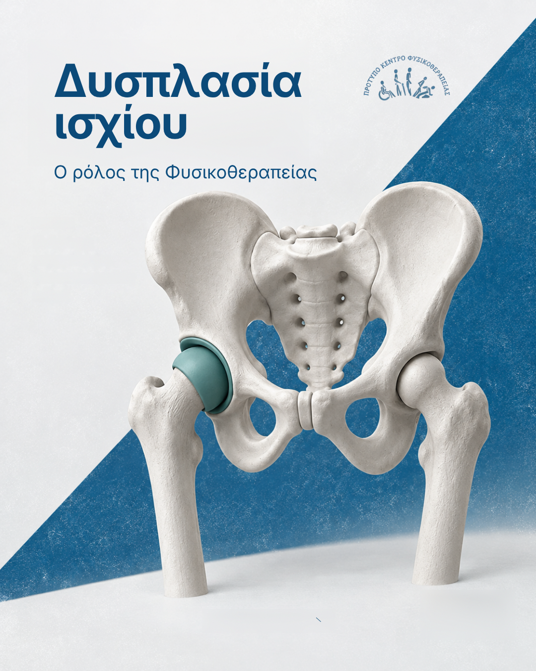 δυσπλασία ισχίου — ενημερωτικό γραφικό του Physiovolos